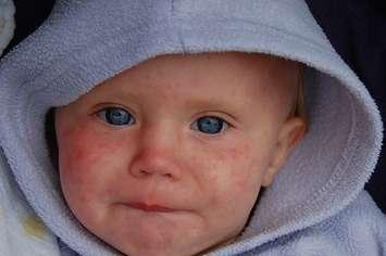 Child with measles by Dave Haygarth via Flickr